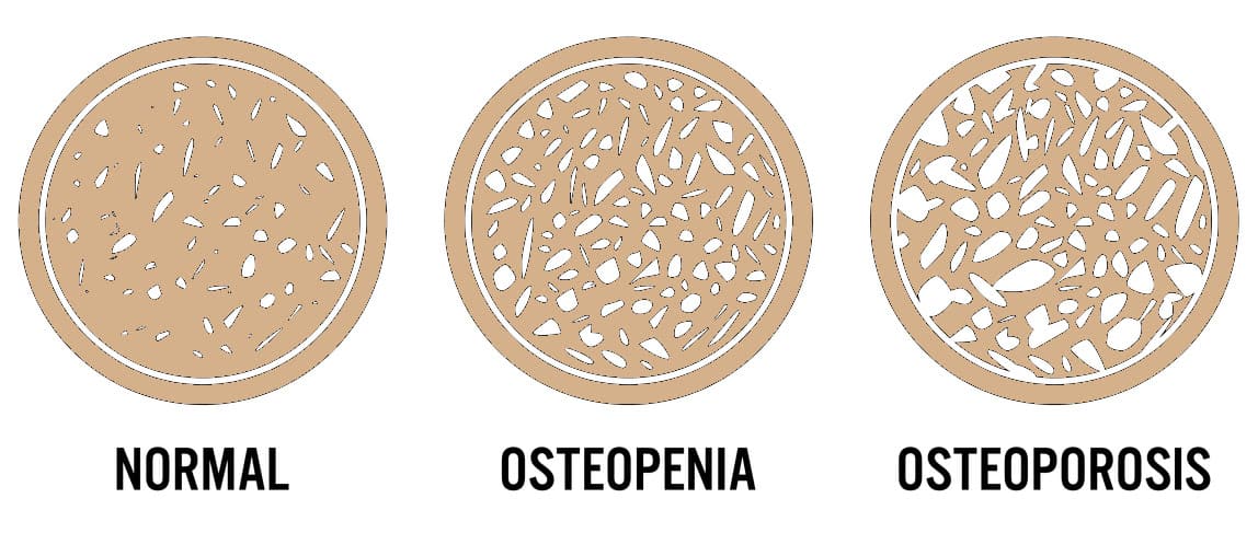 stages of osteoporosis